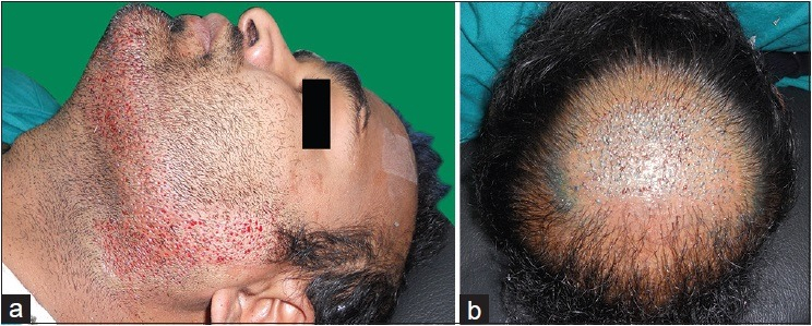 Beard hairs placed around the crown and mid-scalp.