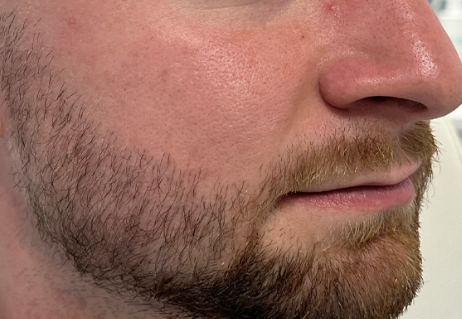 Beard transplant, 1500 grafts