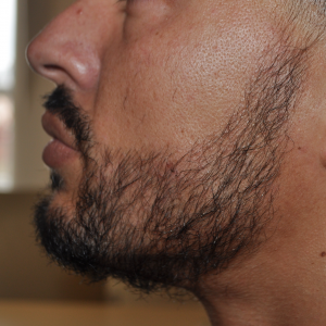 How Much Does A Beard Transplant Cost?, Wimpole Clinic