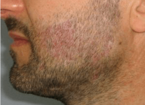 Beard transplant 3 weeks after transplant procedure