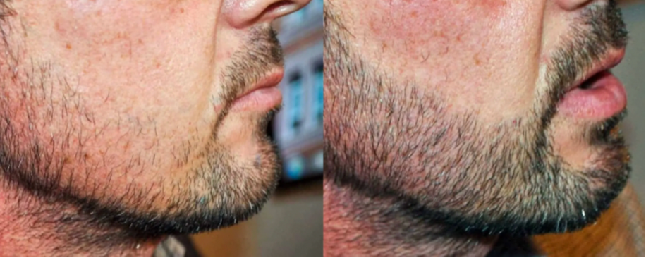 Beard Transplant Gone Wrong? An Expert’s Advice On What To Do Next, Wimpole Clinic