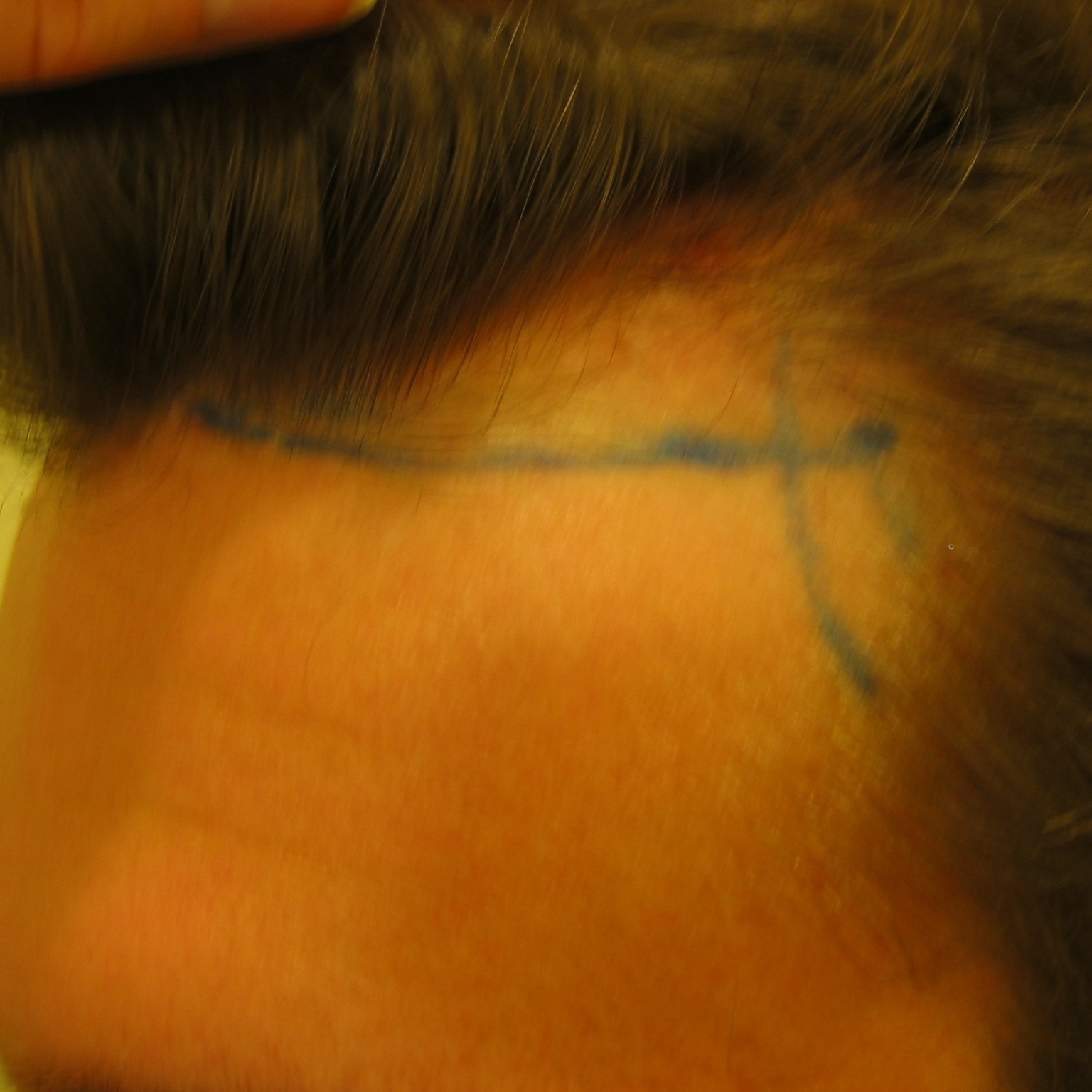 Hair Transplant After 4 Months: Photos, Results, Side Effects, Wimpole Clinic