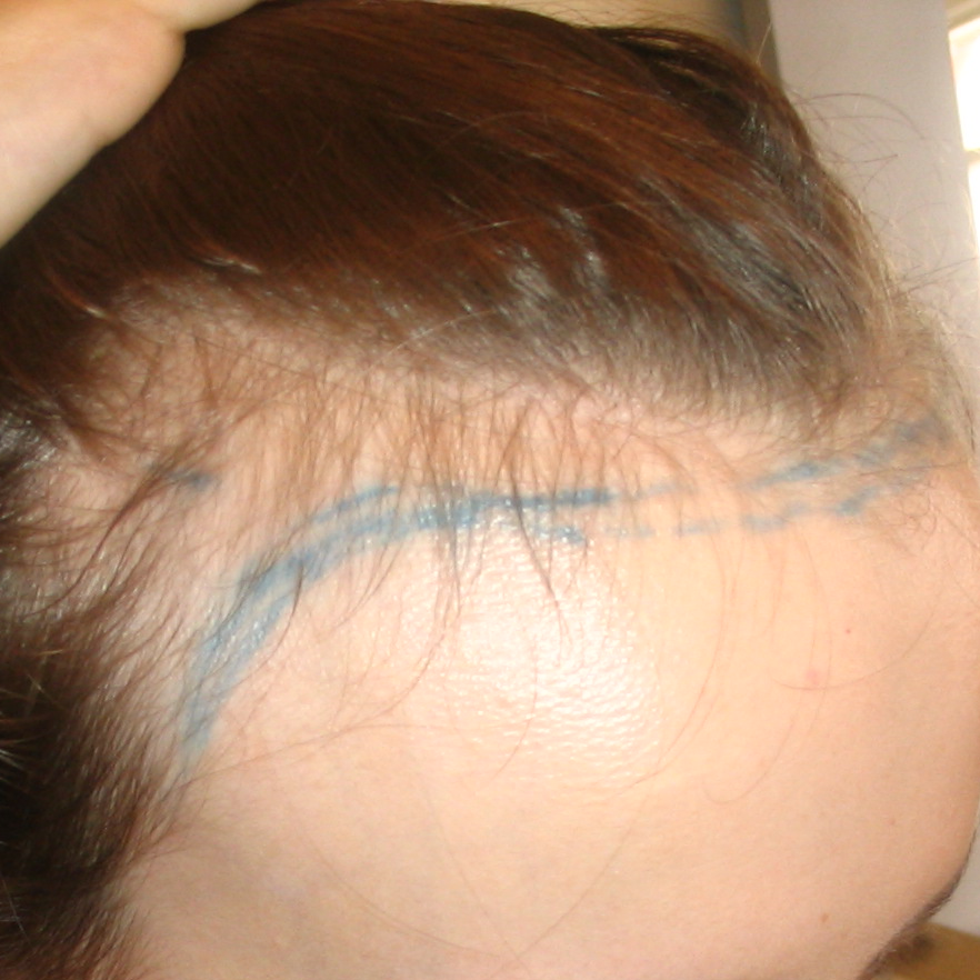 Androgenetic Alopecia: Causes, Diagnosis &#038; Treatment, Wimpole Clinic