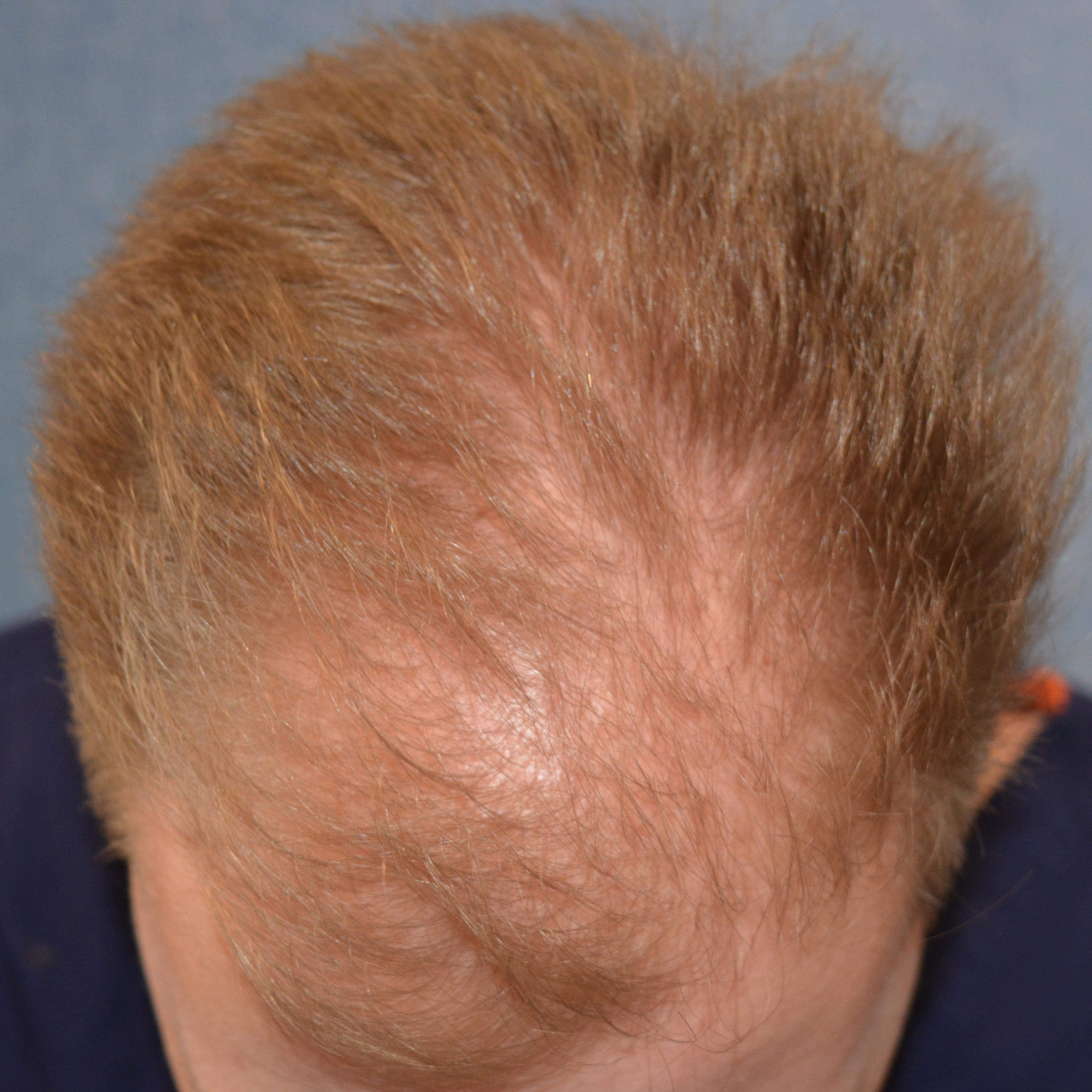 1000 Graft Hair Transplant: Coverage, Costs, Results, Wimpole Clinic