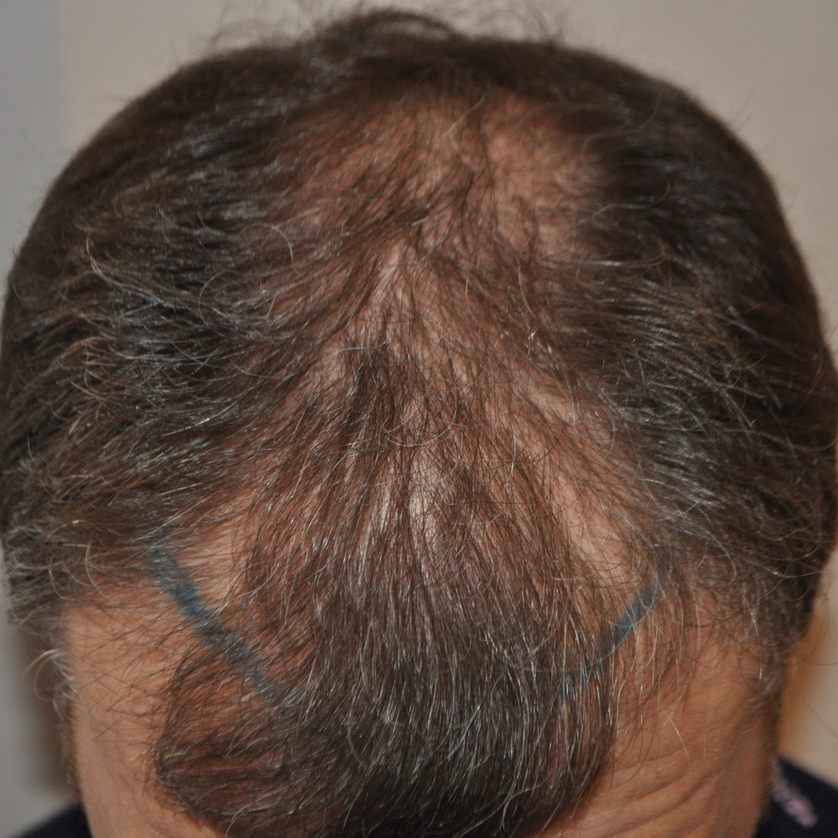 Norwood Stage 4 Photos, Treatments, Results Wimpole Clinic