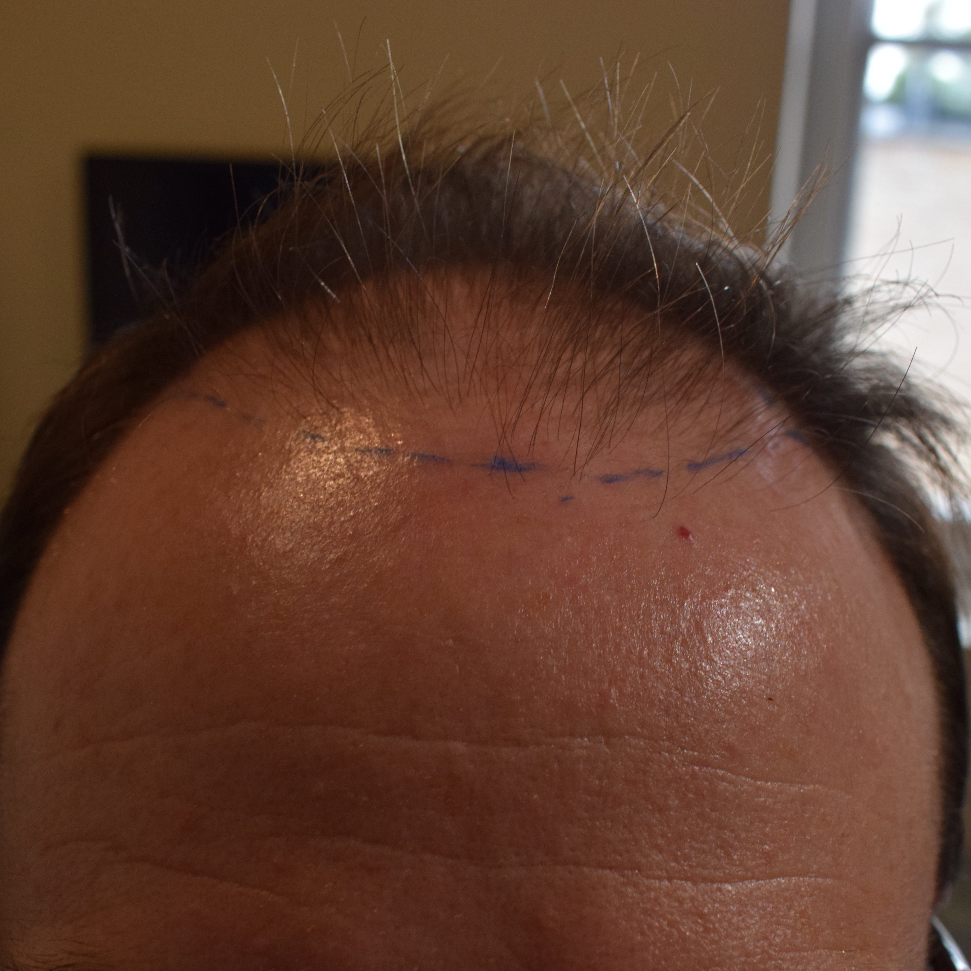 Hair Transplant After 1 Month: Photos, Results, Side Effects
