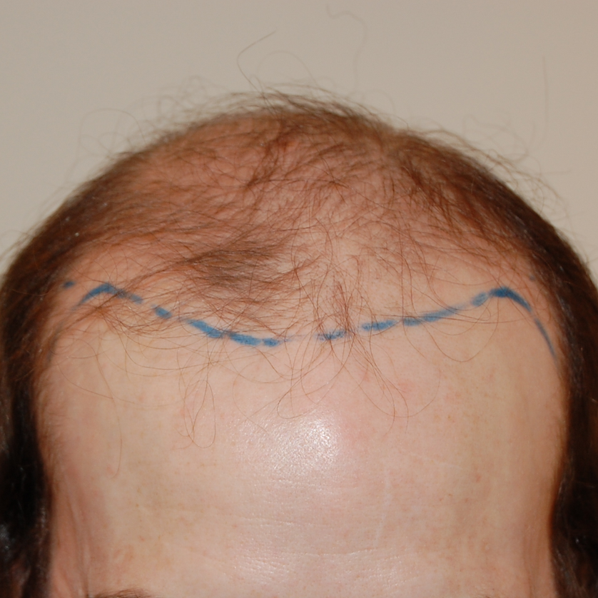 5000 Graft Hair Transplant: Coverage, Costs, Results