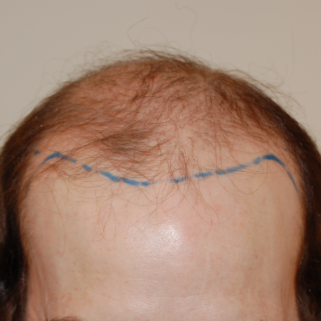 5000 Graft Hair Transplant: Coverage, Costs, Results, Wimpole Clinic