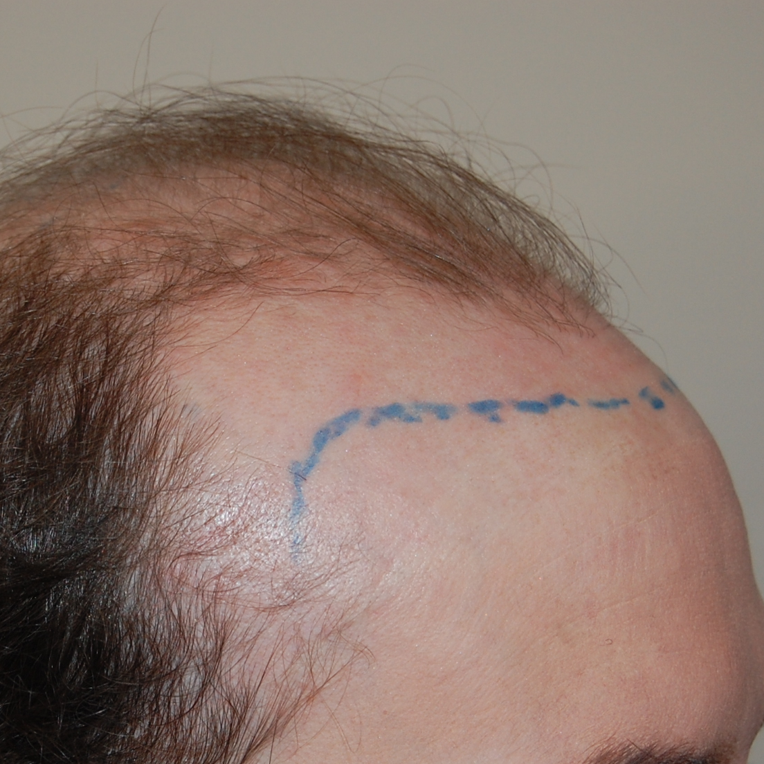 4000 Graft Hair Transplant: Coverage, Results, Costs, Wimpole Clinic