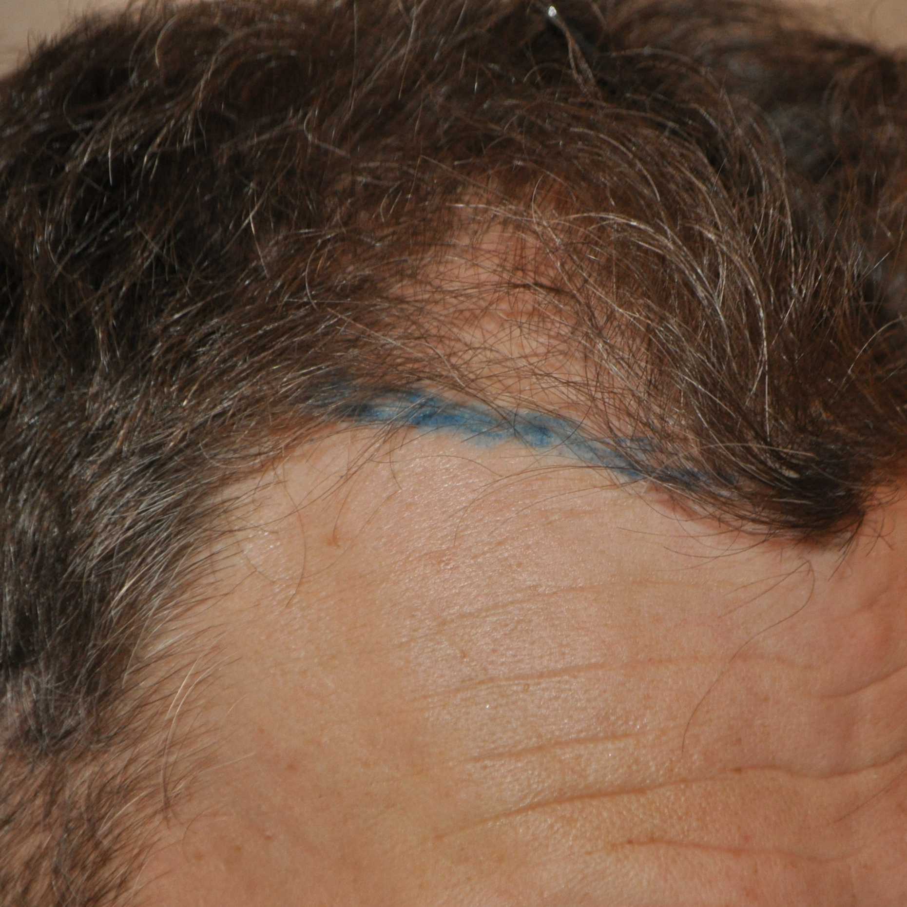 500 Graft Hair Transplant: Coverage, Results, Costs, Wimpole Clinic