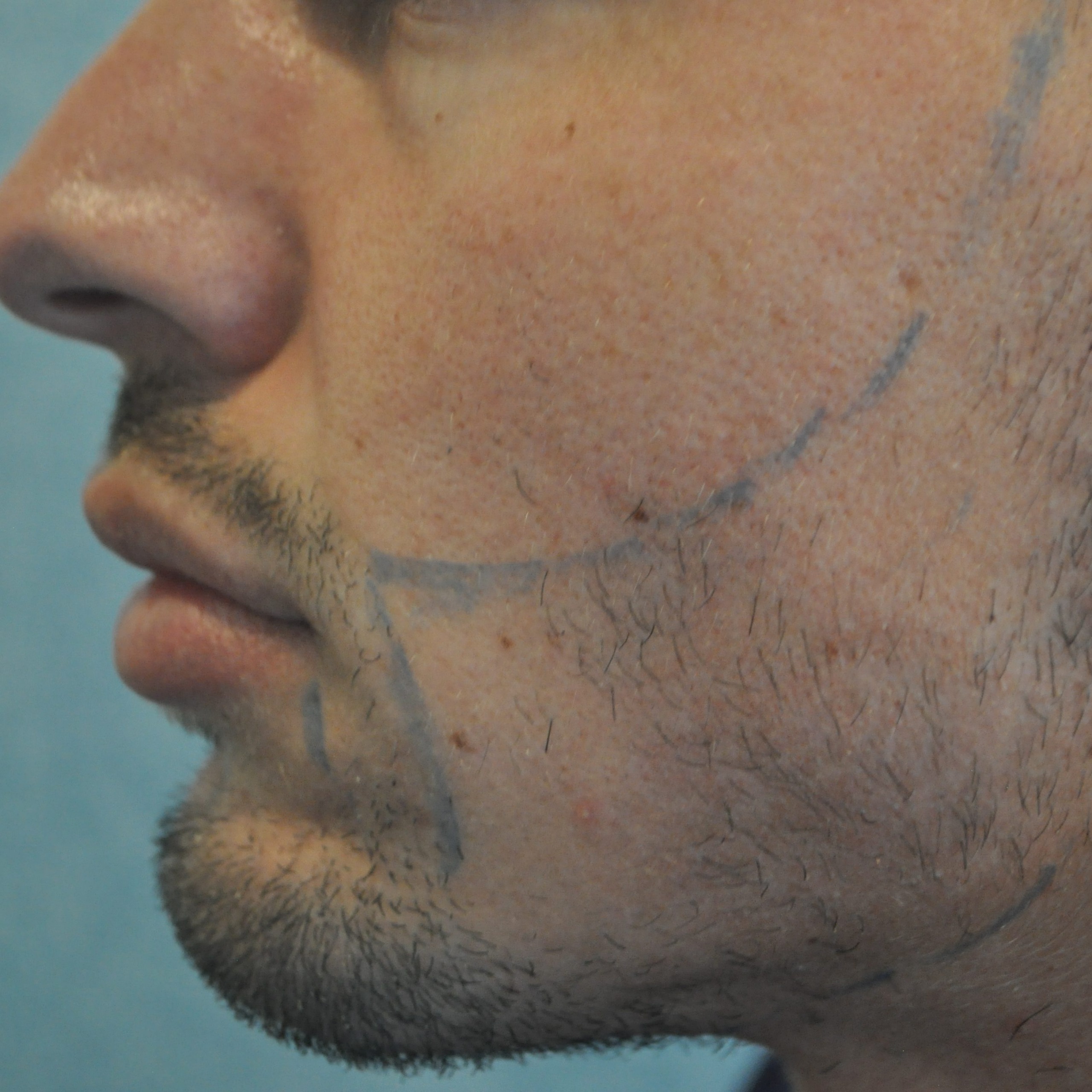 How Much Does A Beard Transplant Cost?, Wimpole Clinic