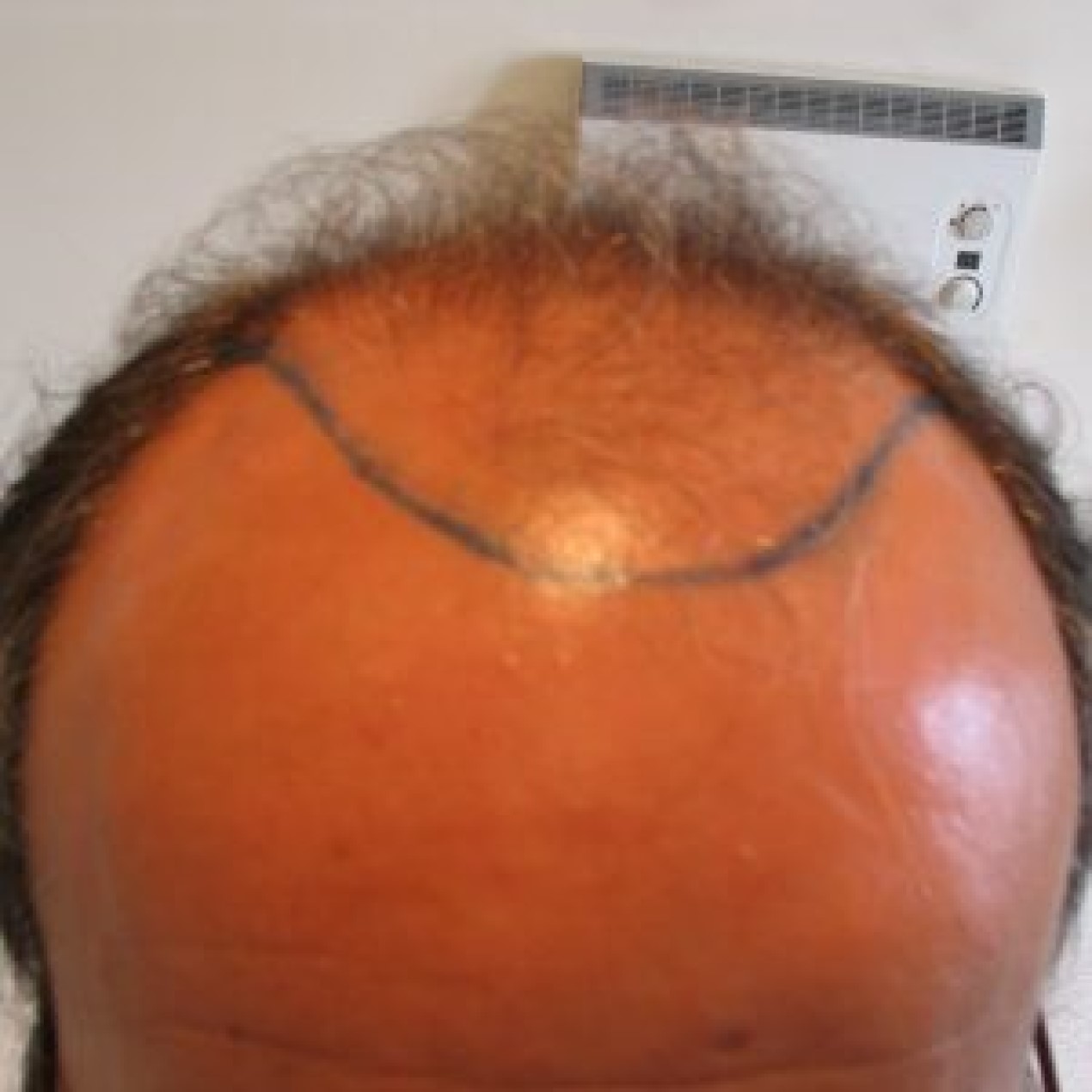 Hair Transplant After 3 Months: Photos, Results, Side Effects