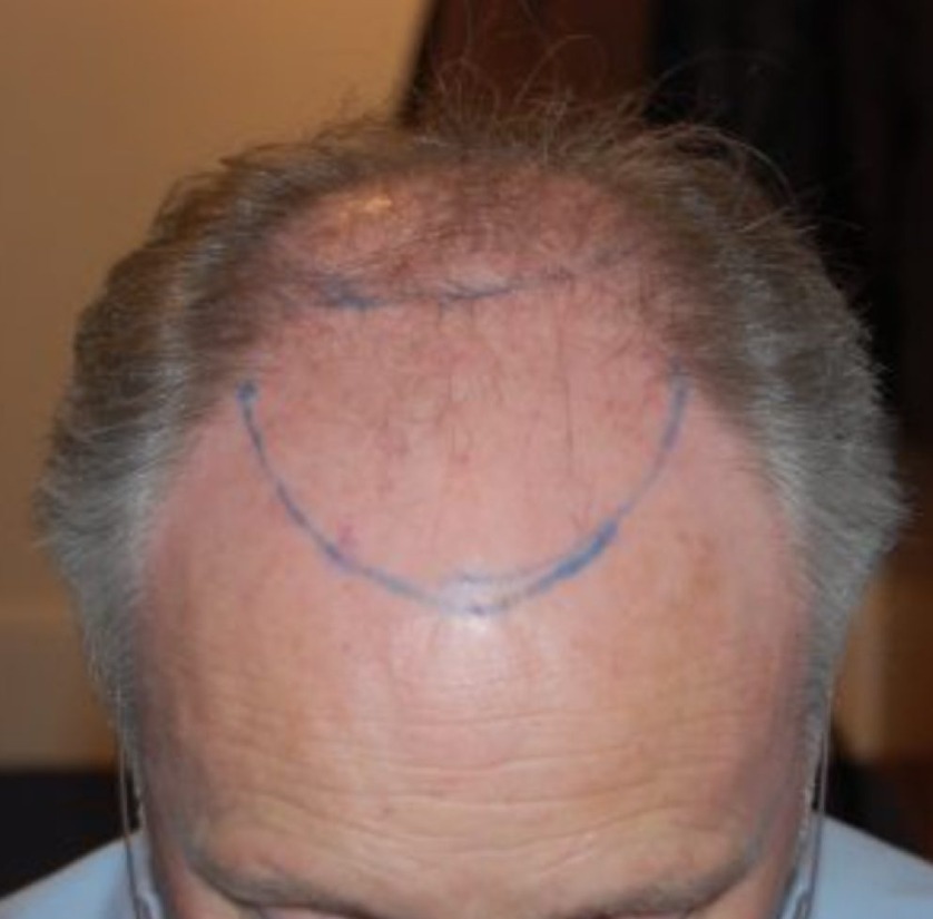Hair Transplant After 3 Months Photos, Results, Side Effects
