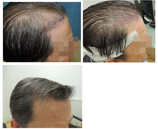 Unshaven recepient area UFUE, before & after