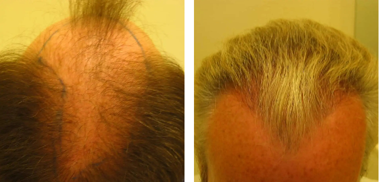 Before and 11 months after hair transplant