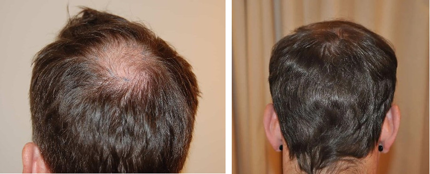 Hair Transplant Timeline: Preparation, Recovery & Results