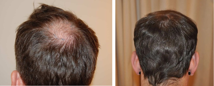 Before and 12 months after hair transplant