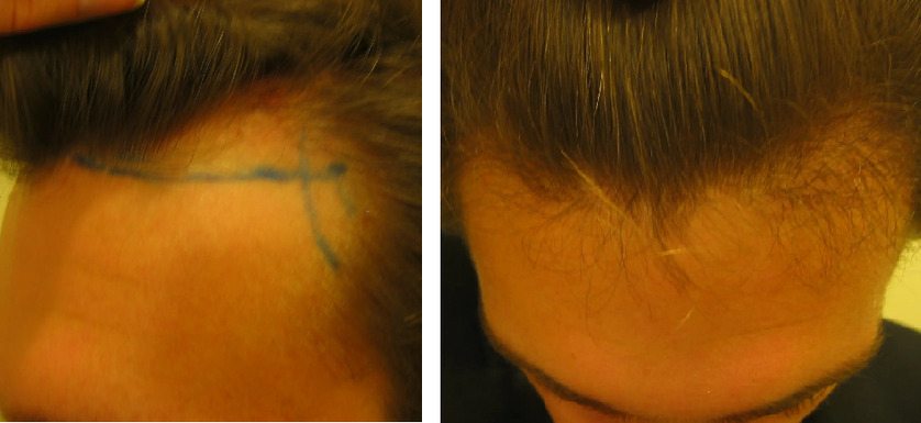 Hair Transplant After 4 Months: Photos, Results, Side Effects