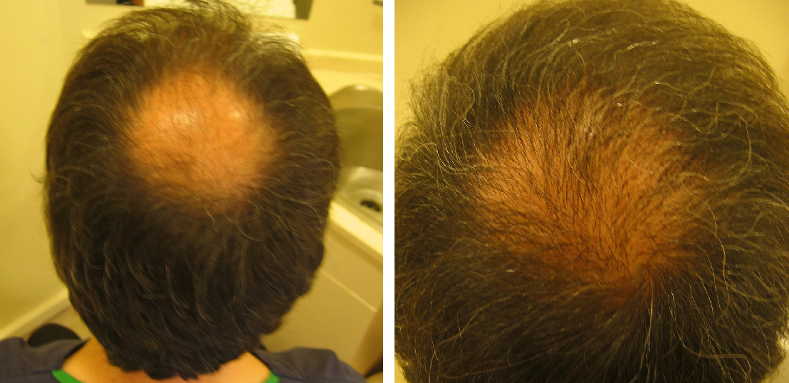 Before and 5 months after crown transplant