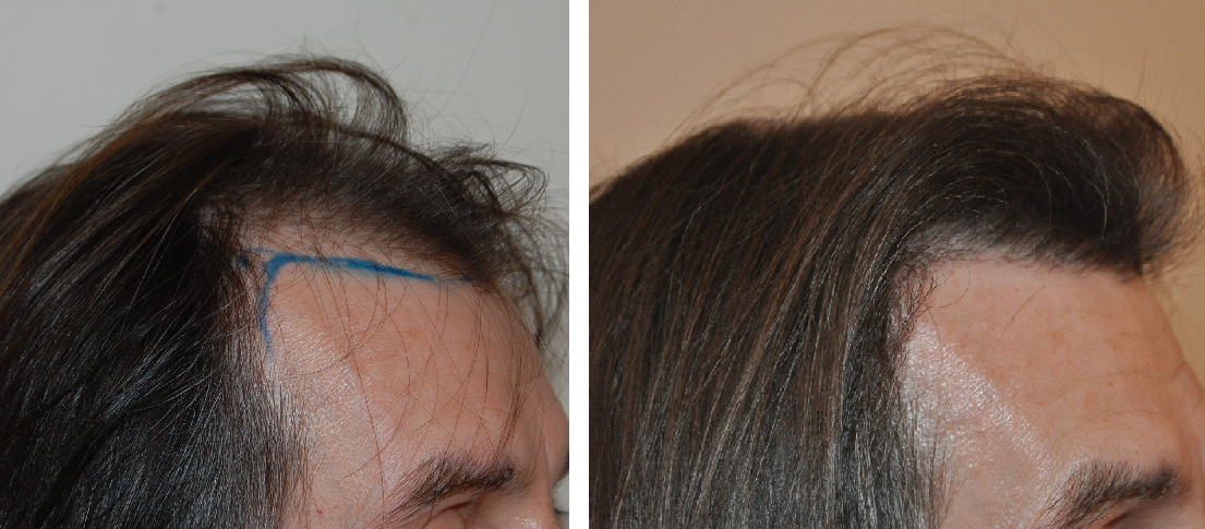 Before and 7 months after hair transplant surgery