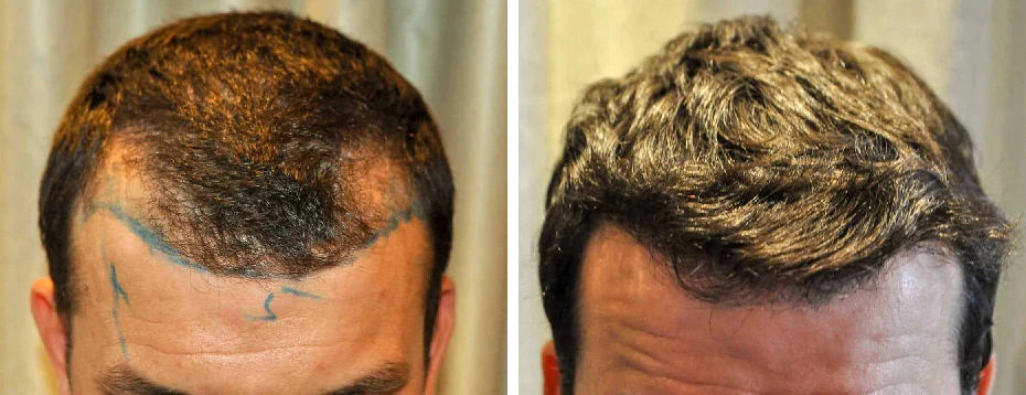 Before and 8 months after FUE transplant