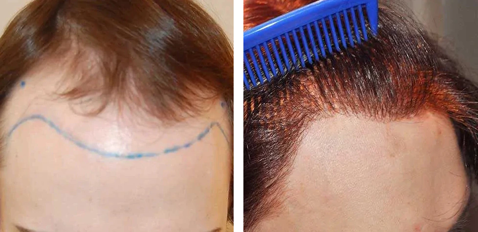 Before and 9 months after FUE hair transplant surgery