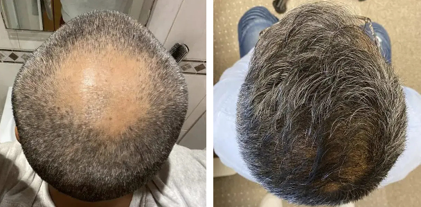 Before and after 2500 graft hair transplant