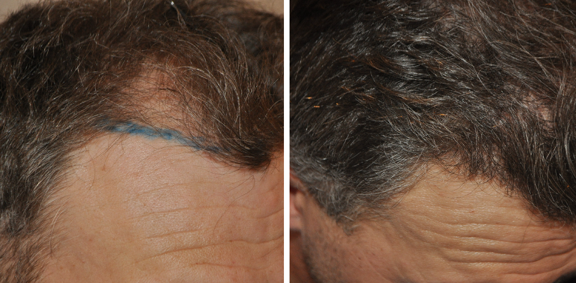 Before and after 500 graft FUE hair transplant
