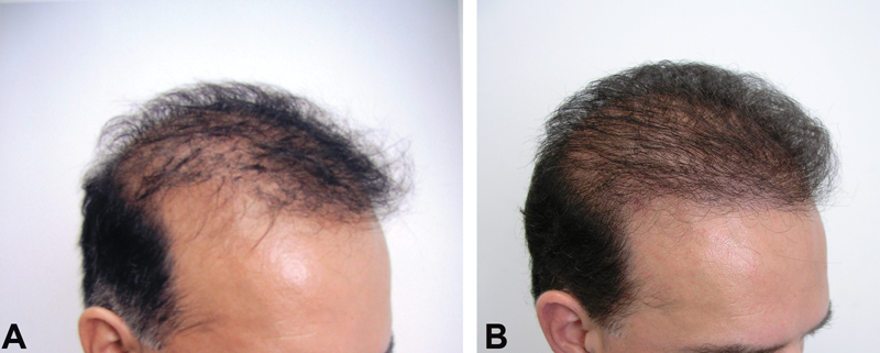 Before and after hair transplant repair using torso hair.