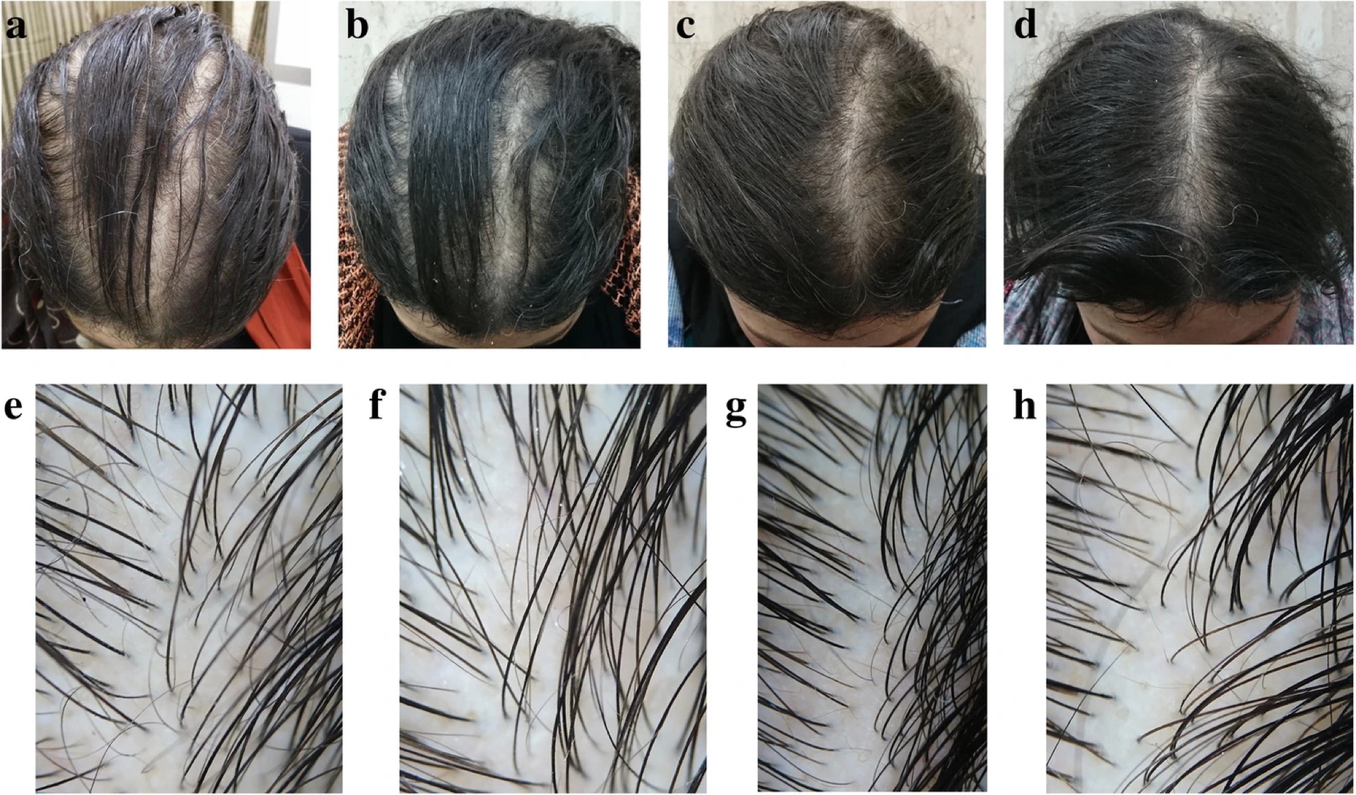 Before and after photos of patient using 2% Minoxidil