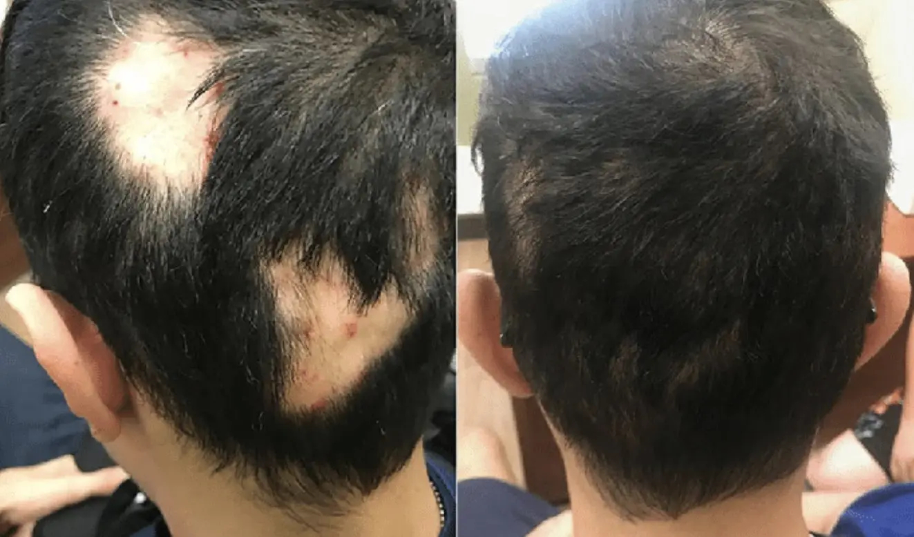 Before and after results of using Minoxidil and steroid creams on alopecia areata