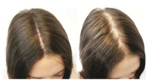 Before and after thinning of the midline parting