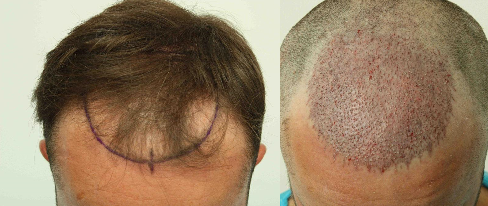 Hair Transplant Result After 20 Days - YouTube
