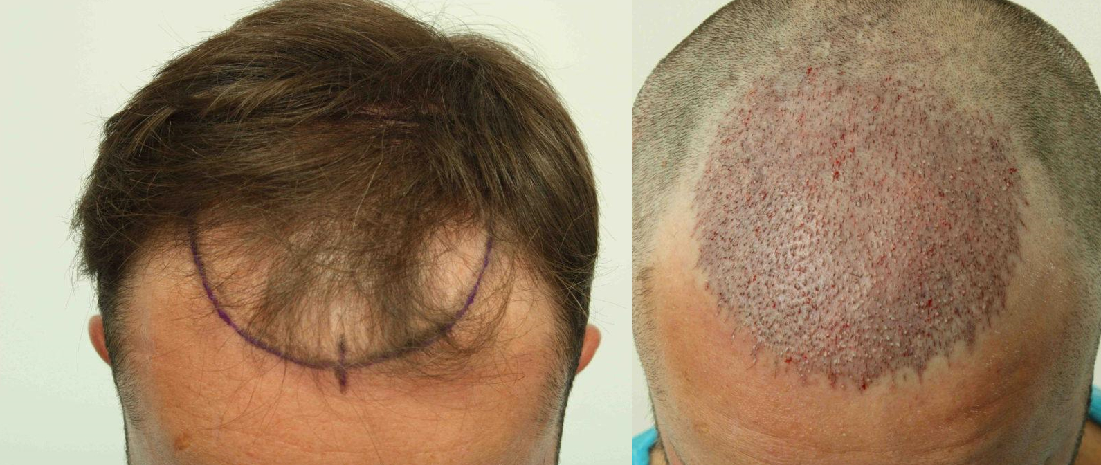 Before and immediately after hair transplant procedure