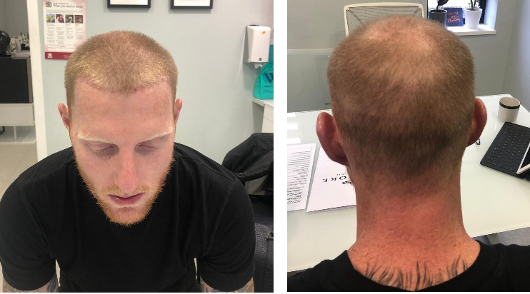 Ben Stokes a few weeks after hair transplant surgery