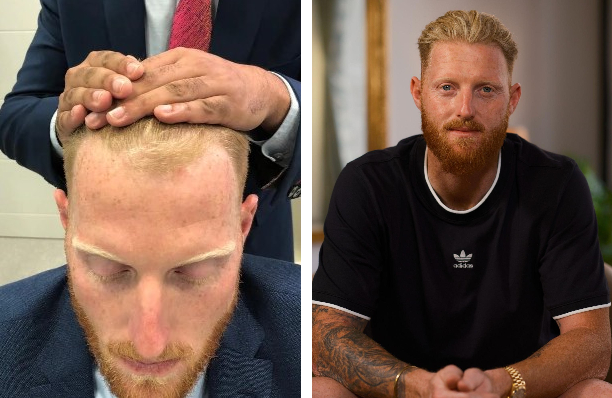 Ben Stokes before and after hair transplant at the Wimpole Clinic