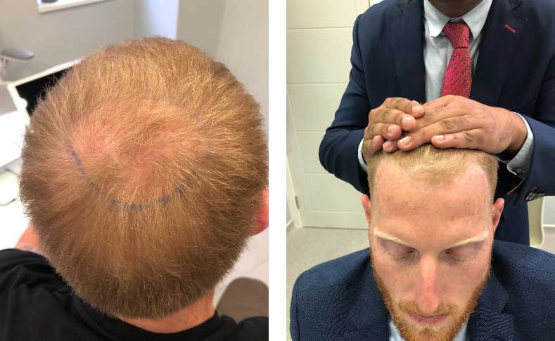 Before Ben Stokes' hair transplant at the Wimpole Clinic