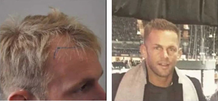Benjamin Lewitt before and after hair transplant