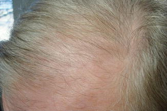 Beta blocker induced hair thinning