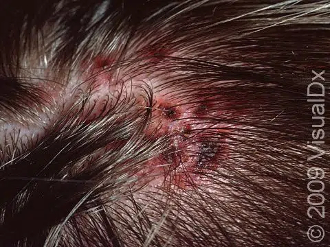 Bleeding sores and scalp scabs as a result of scratching due to the presence of lice