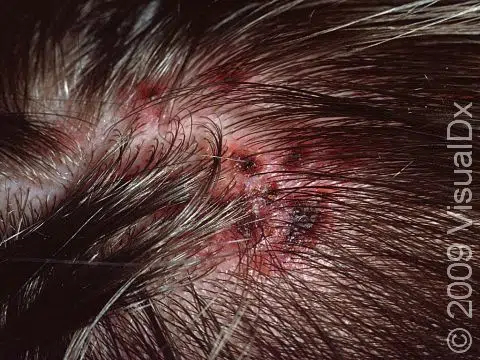 scalp scabs picking