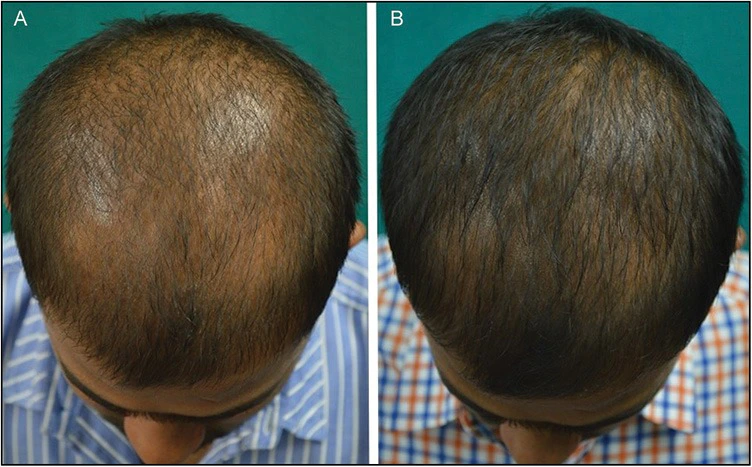 Before and after hair growth results from Botox scalp injections