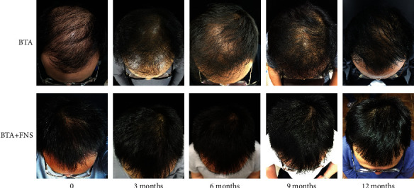 Images comparing the effectiveness of botox injections with botox and Finasteride after 3, 6, 9, and 12 months.