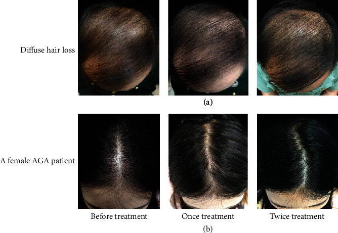 Effectiveness of botox for diffuse thinning and female pattern hair loss at baseline, then after the first and second treatment.