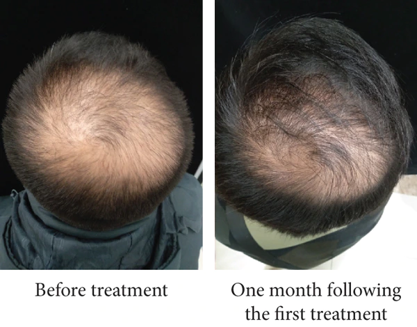 Male pattern baldness patient before treatment and one month after Botox scalp injections.