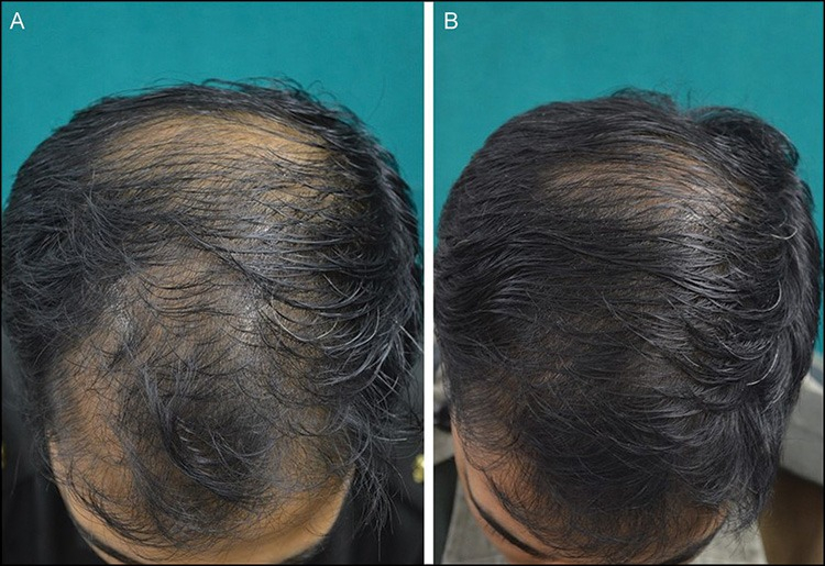 Response to botox scalp injections at baseline and after 24 weeks,