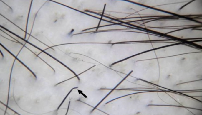 broken hair and split ends from a Trichotillomania patient