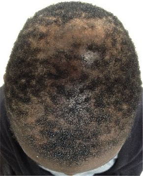 Scarring Alopecia: Causes, Stages & Treatment Options | Wimpole Clinic