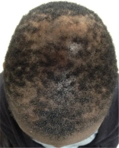 Example of central centrifugal cicatricial alopecia