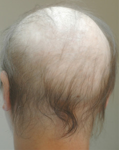Example of Chemotherapy-induced alopecia